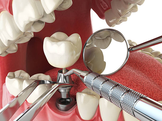 Best Emergency Dental Extractions in Winfield, IA